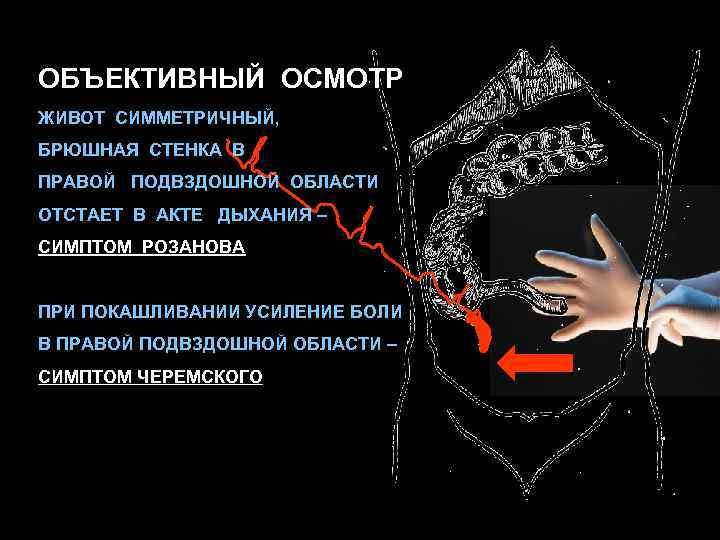 Боль в правой подвздошной. Усиление боли при покашливании симптом. Боли в животе в правой подвздошной области. Объективное обследование области живота. Боль в желудке в подвздошной области.