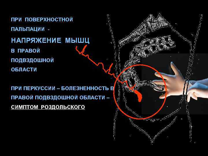 Болезненность при пальпации. Пальпация правой подвздошной области. Напряжение мышц в правой подвздошной области. Болезненная пальпация правой подвздошной области. Болезненность при пальпации в правой подвздошной области.