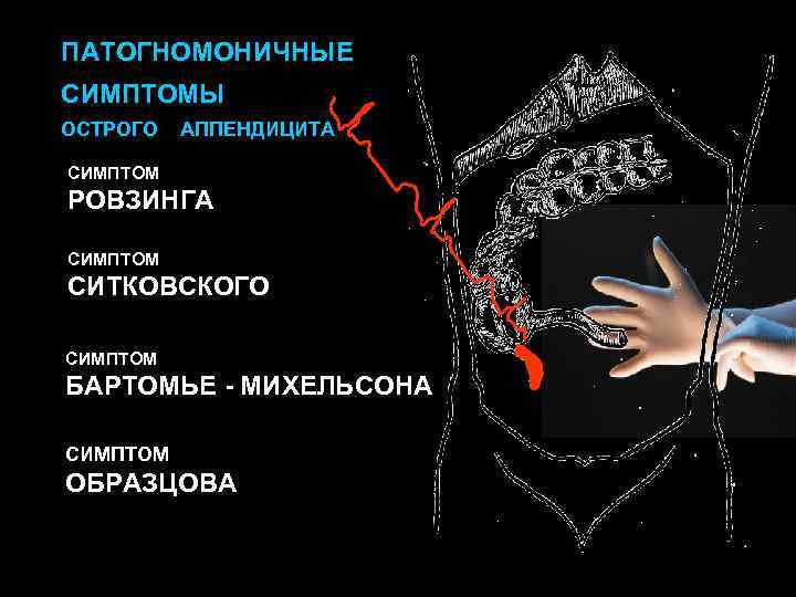 Патогномоничный симптом это. Острый аппендицит симптом Образцова. Патогномоничные симптомы аппендицита. Патогномоничный синдром острого аппендицита. Патогномоничными симптомами острого аппендицита являются:.