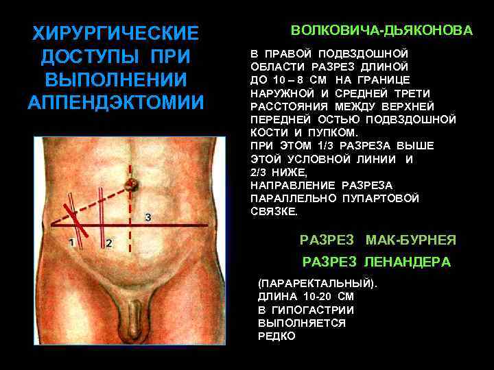 ХИРУРГИЧЕСКИЕ ДОСТУПЫ ПРИ ВЫПОЛНЕНИИ АППЕНДЭКТОМИИ РАЗРЕЗ ВОЛКОВИЧА-ДЬЯКОНОВА В ПРАВОЙ ПОДВЗДОШНОЙ ОБЛАСТИ РАЗРЕЗ ДЛИНОЙ ДО