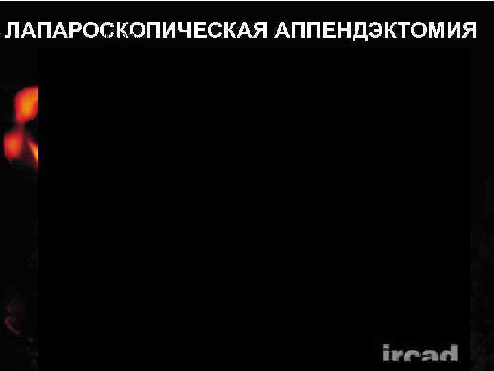 ЛАПАРОСКОПИЧЕСКАЯ АППЕНДЭКТОМИЯ 