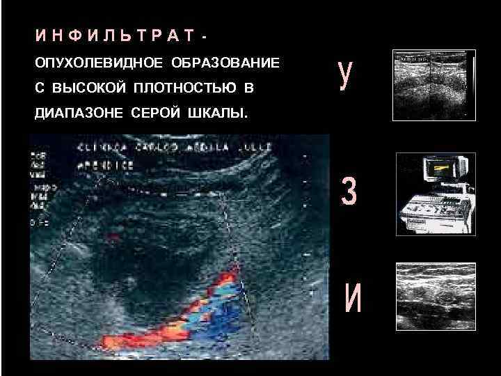 ИНФИЛЬТРАТ ОПУХОЛЕВИДНОЕ ОБРАЗОВАНИЕ С ВЫСОКОЙ ПЛОТНОСТЬЮ В ДИАПАЗОНЕ СЕРОЙ ШКАЛЫ. 