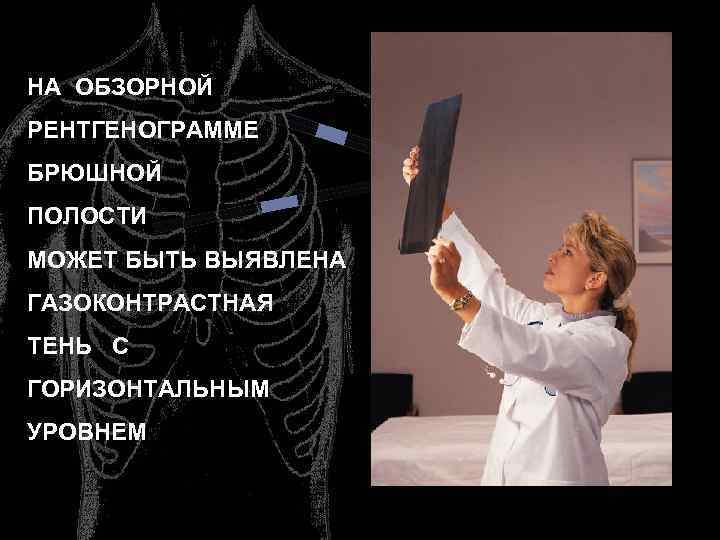 НА ОБЗОРНОЙ РЕНТГЕНОГРАММЕ БРЮШНОЙ ПОЛОСТИ МОЖЕТ БЫТЬ ВЫЯВЛЕНА ГАЗОКОНТРАСТНАЯ ТЕНЬ С ГОРИЗОНТАЛЬНЫМ УРОВНЕМ 