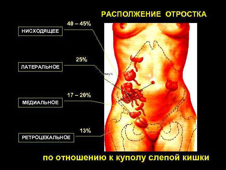 Где расположен аппендицит у человека схема расположения у женщин фото