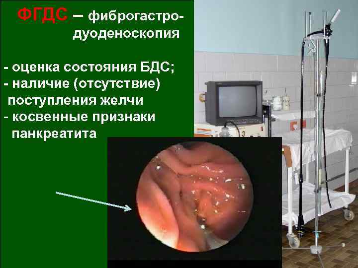 ФГДС – фиброгастродуоденоскопия - оценка состояния БДС; - наличие (отсутствие) поступления желчи - косвенные