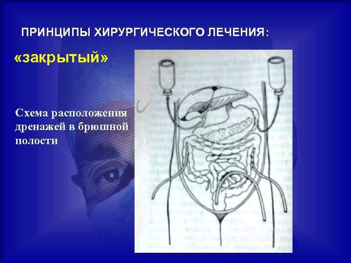 ПРИНЦИПЫ ХИРУРГИЧЕСКОГО ЛЕЧЕНИЯ: «закрытый» Схема расположения дренажей в брюшной полости 