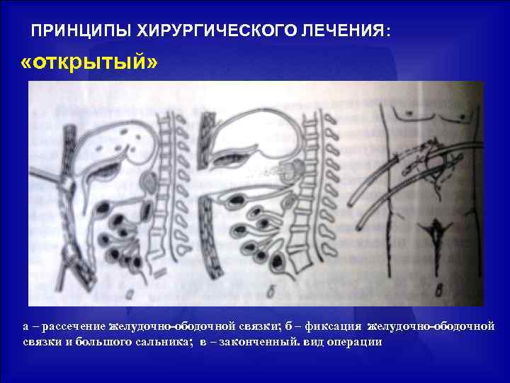 Панкреатит факультетская хирургия презентация