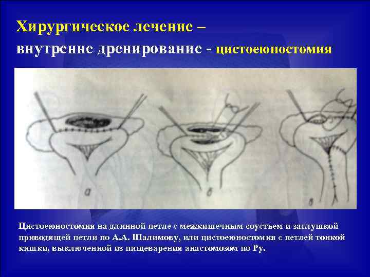 Хирургическое лечение – внутренне дренирование - цистоеюностомия Цистоеюностомия на длинной петле с межкишечным соустьем