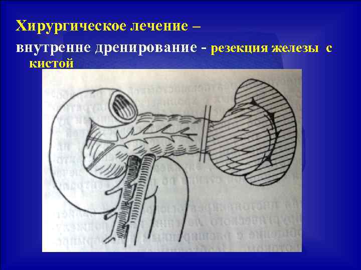 Панкреатит факультетская хирургия презентация