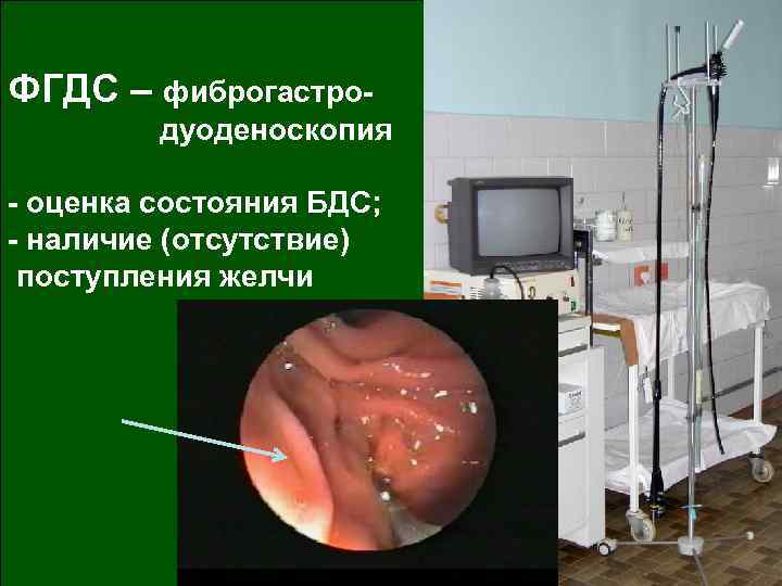 ФГДС – фиброгастродуоденоскопия - оценка состояния БДС; - наличие (отсутствие) поступления желчи 