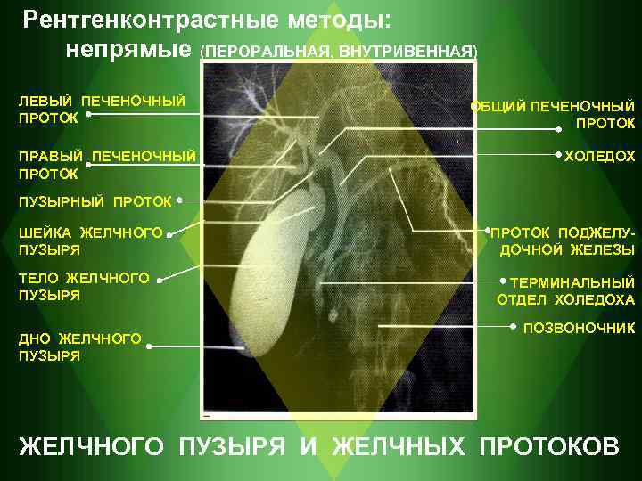 Рентгенконтрастные методы: непрямые (ПЕРОРАЛЬНАЯ, ВНУТРИВЕННАЯ) ЛЕВЫЙ ПЕЧЕНОЧНЫЙ ПРОТОК ПРАВЫЙ ПЕЧЕНОЧНЫЙ ПРОТОК ОБЩИЙ ПЕЧЕНОЧНЫЙ ПРОТОК
