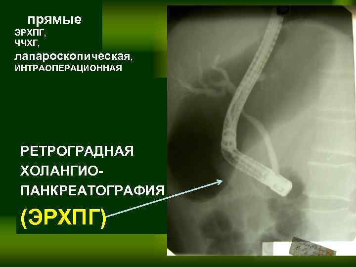 Холедохолитиаз что это такое