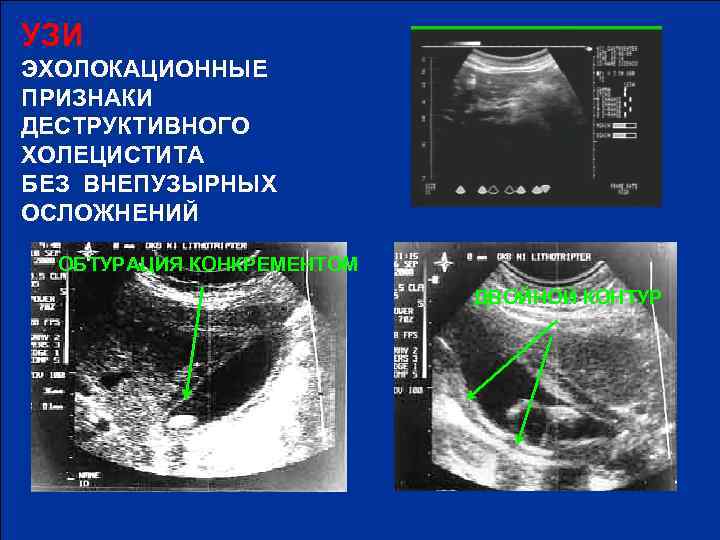 УЗИ ЭХОЛОКАЦИОННЫЕ ПРИЗНАКИ ДЕСТРУКТИВНОГО ХОЛЕЦИСТИТА БЕЗ ВНЕПУЗЫРНЫХ ОСЛОЖНЕНИЙ ОБТУРАЦИЯ КОНКРЕМЕНТОМ ДВОЙНОЙ КОНТУР 