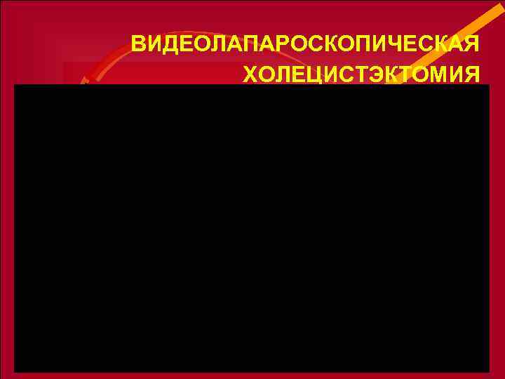 ВИДЕОЛАПАРОСКОПИЧЕСКАЯ ХОЛЕЦИСТЭКТОМИЯ ОПЕРАЦИЯ ВЫПОЛНЯЕТСЯ ИЗ 4 -Х ПРОКОЛОВ БРЮШНОЙ СТЕНКИ С ПОМОЩЬЮ МАНИПУЛЯТОРОВ ЖЕЛЧНЫЙ