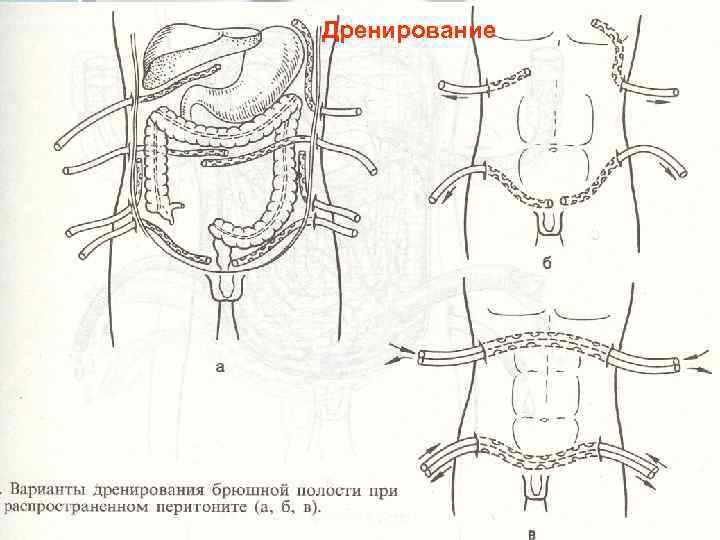  Дренирование Кафедра факультетской хирургии и  39 