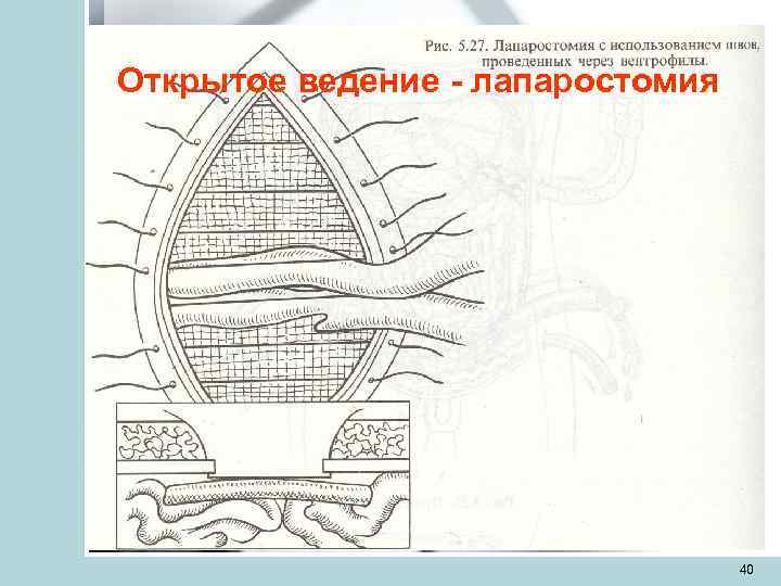 Открытое ведение - лапаростомия    40 