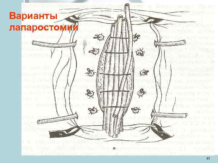 Варианты лапаростомии    41 