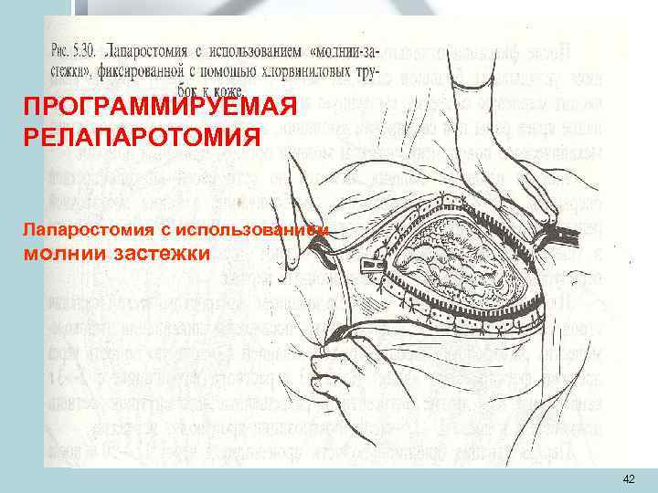 ПРОГРАММИРУЕМАЯ РЕЛАПАРОТОМИЯ  Лапаростомия с использованием молнии застежки      