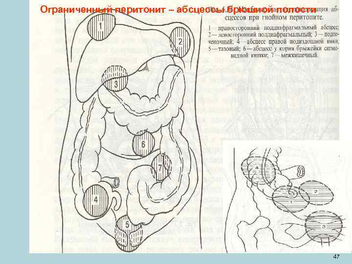 Ограниченный перитонит – абсцессы брюшной полости      47 
