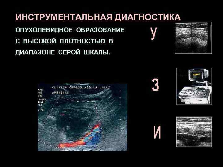 ИНСТРУМЕНТАЛЬНАЯ ДИАГНОСТИКА ОПУХОЛЕВИДНОЕ ОБРАЗОВАНИЕ С ВЫСОКОЙ ПЛОТНОСТЬЮ В ДИАПАЗОНЕ СЕРОЙ ШКАЛЫ. 