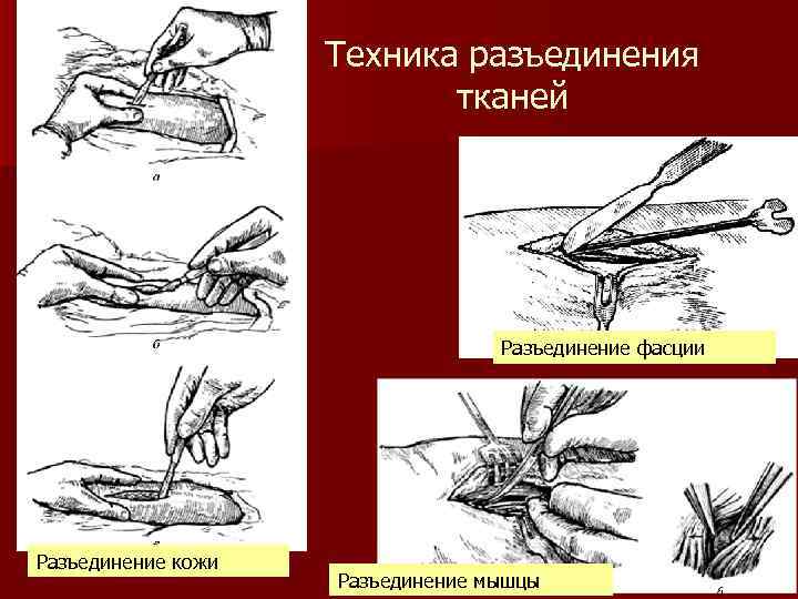 Техника разъединения тканей Разъединение фасции Разъединение кожи Разъединение мышцы 