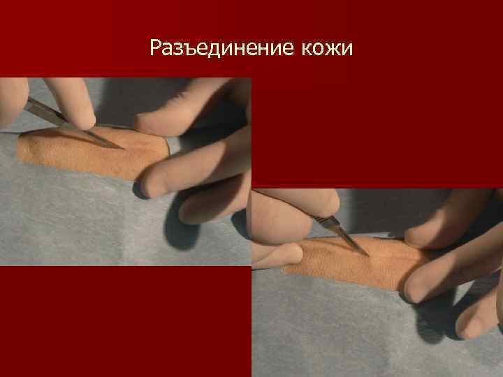 Разъединение кожи 