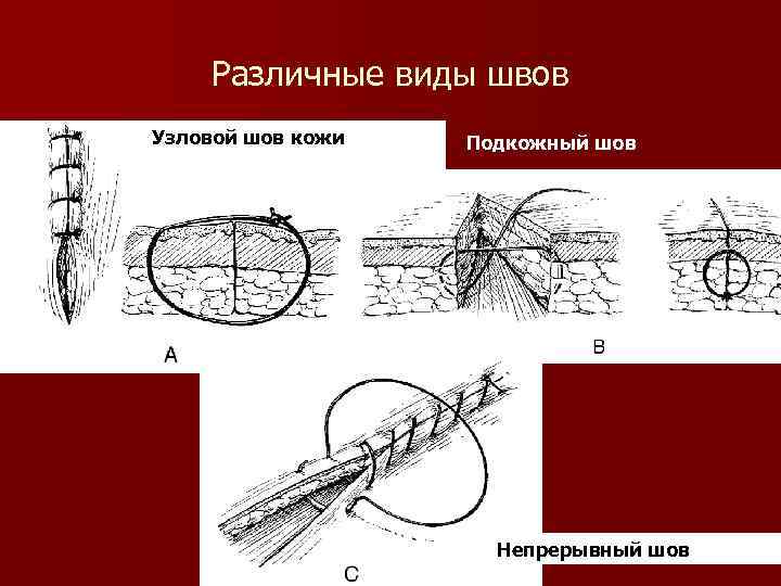 Различные виды швов Узловой шов кожи Подкожный шов Непрерывный шов 