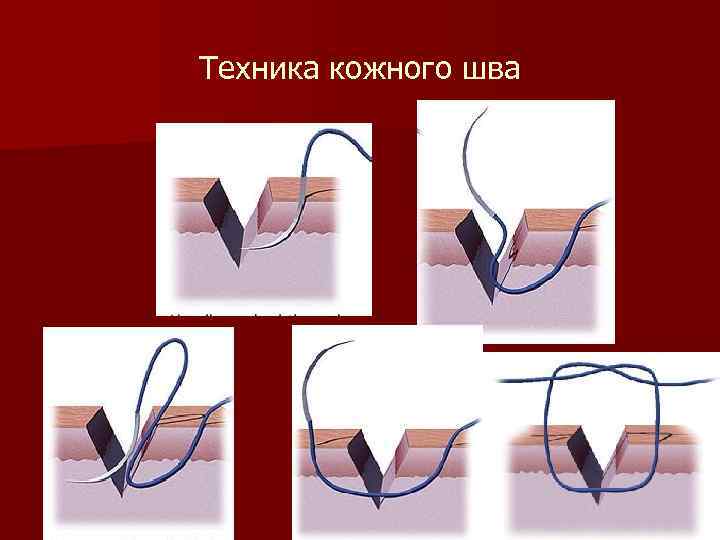 Техника кожного шва 