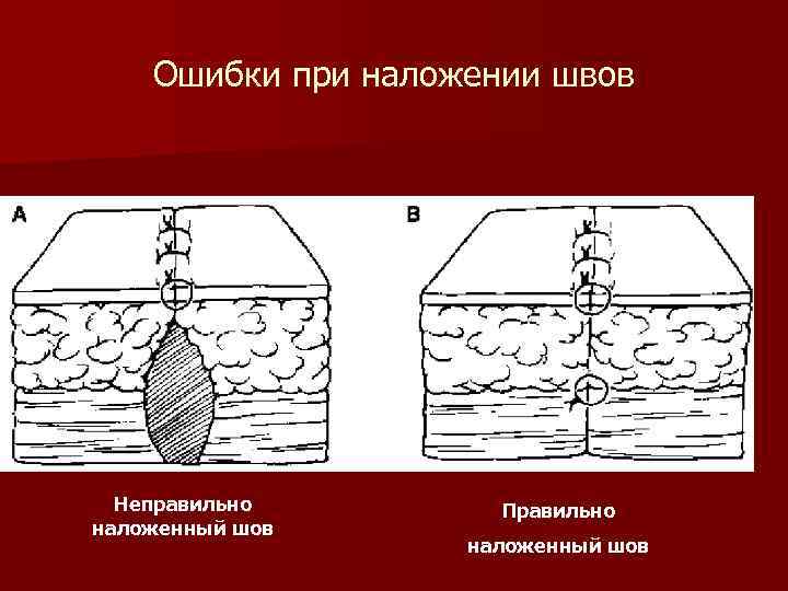 Ошибки при наложении швов Неправильно наложенный шов Правильно наложенный шов 