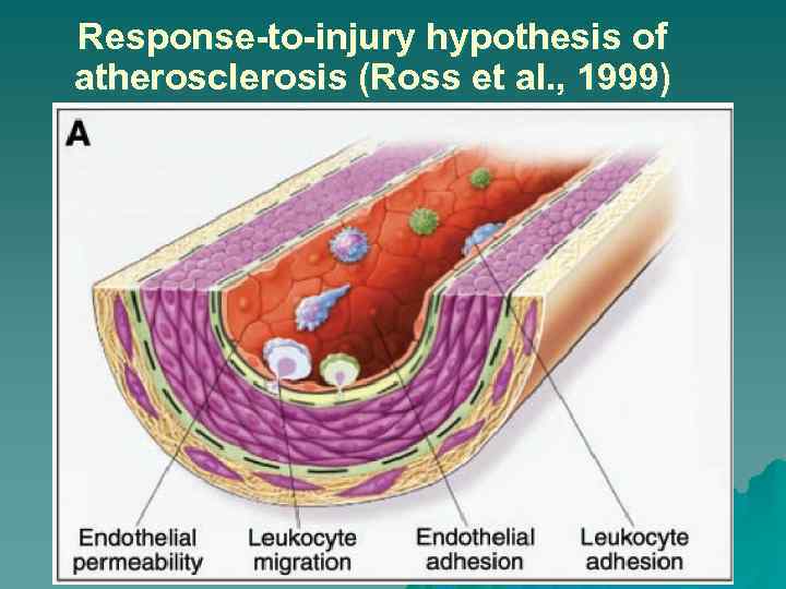 Response-to-injury hypothesis of atherosclerosis (Ross et al. , 1999) 