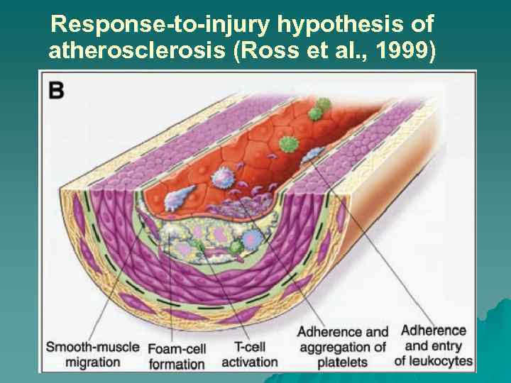 Response-to-injury hypothesis of atherosclerosis (Ross et al. , 1999) 