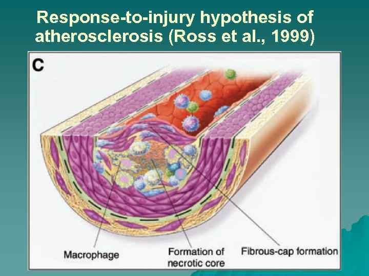 Response-to-injury hypothesis of atherosclerosis (Ross et al. , 1999) 