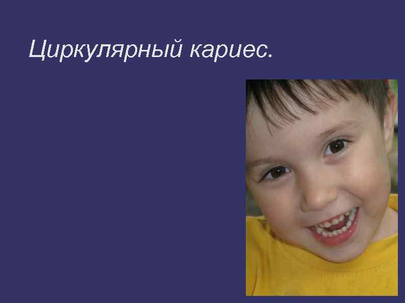 Циркулярный кариес. 