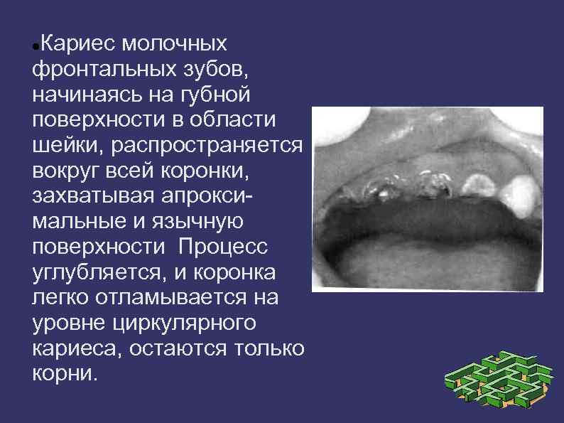 Кариес молочных фронтальных зубов, начинаясь на губной поверхности в области шейки, распространяется вокруг всей