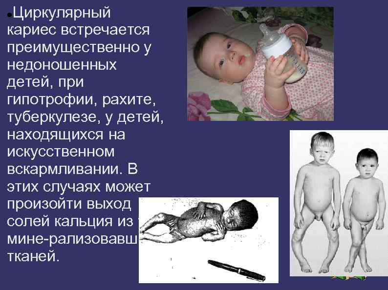 Циркулярный кариес встречается преимущественно у недоношенных детей, при гипотрофии, рахите, туберкулезе, у детей, находящихся