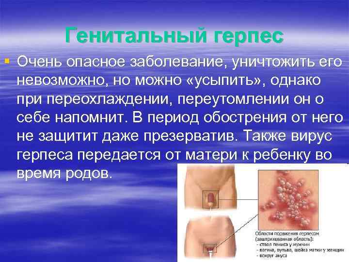 Генитальный герпес § Очень опасное заболевание, уничтожить его невозможно, но можно «усыпить» , однако