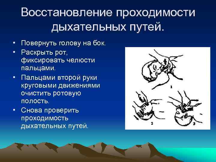 Восстановление проходимости дыхательных путей. • Повернуть голову на бок. • Раскрыть рот, фиксировать челюсти