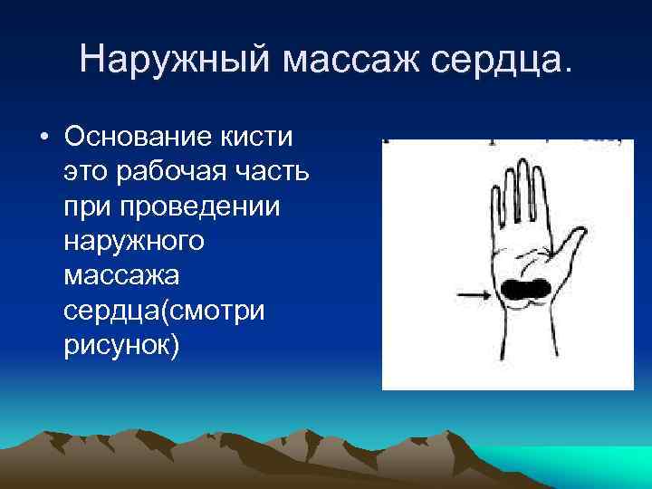 Наружный массаж сердца. • Основание кисти это рабочая часть при проведении наружного массажа сердца(смотри