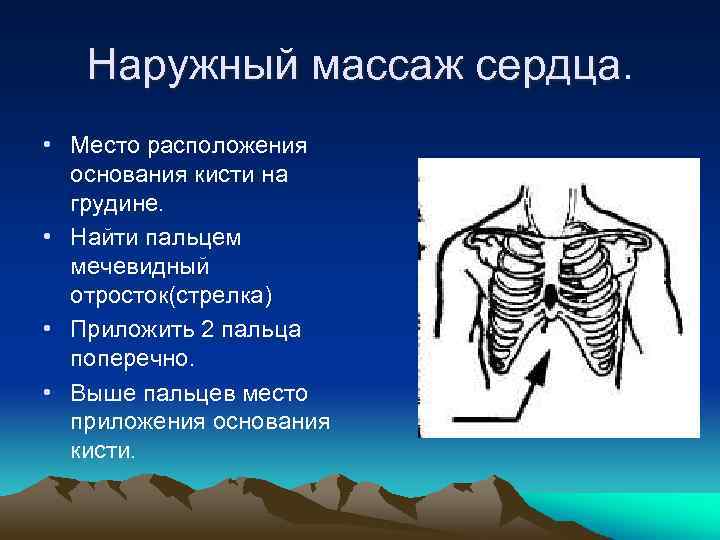 Наружный массаж сердца. • Место расположения основания кисти на грудине. • Найти пальцем мечевидный