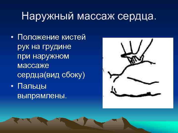 Наружный массаж сердца. • Положение кистей рук на грудине при наружном массаже сердца(вид сбоку)