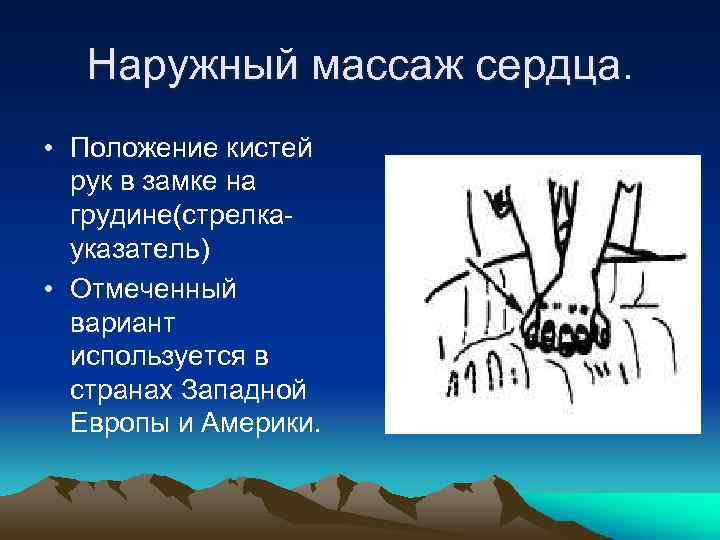 Наружный массаж сердца. • Положение кистей рук в замке на грудине(стрелкауказатель) • Отмеченный вариант