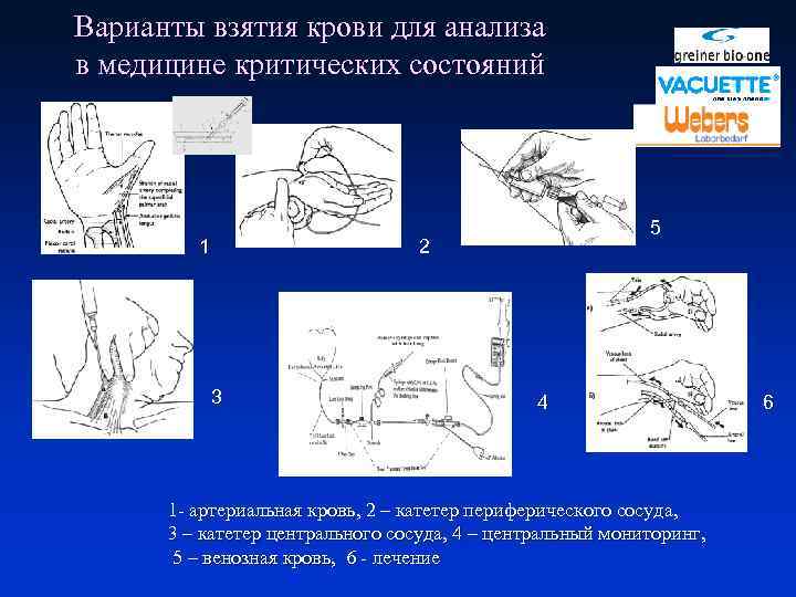 Варианты взятия крови для анализа в медицине критических состояний 1 5 2 3 4