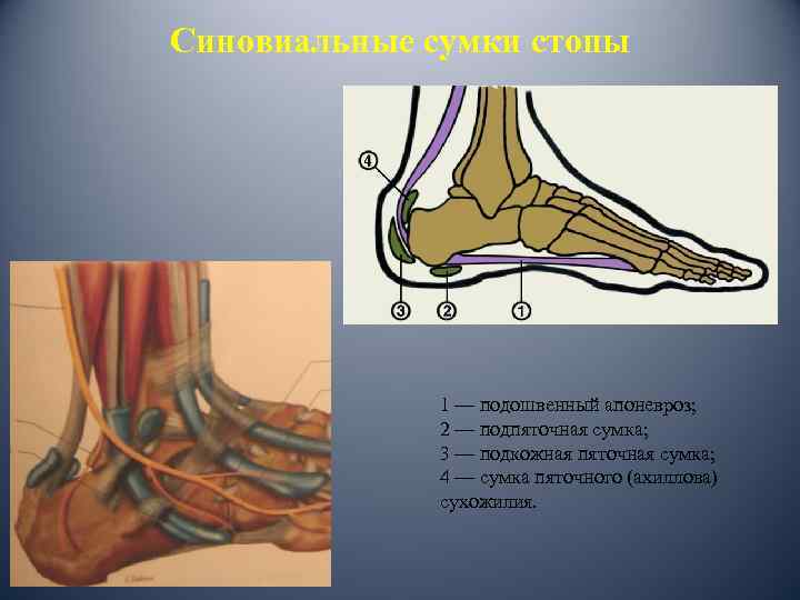 Синовиальные сумки стопы 1 — подошвенный апоневроз; 2 — подпяточная сумка; 3 — подкожная
