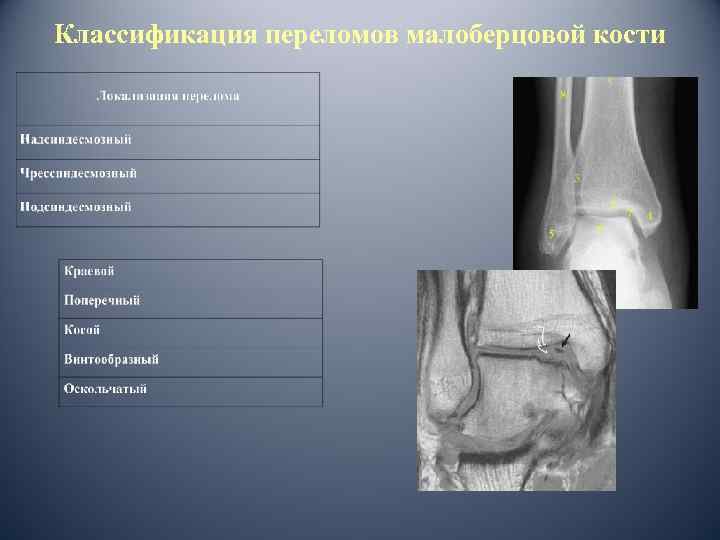 Классификация переломов малоберцовой кости 