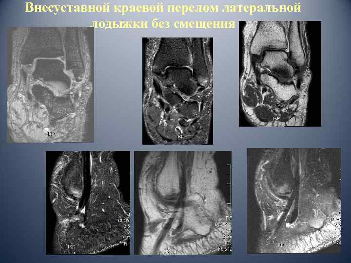 Внесуставной краевой перелом латеральной лодыжки без смещения 