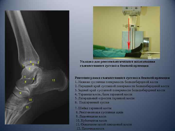Укладка для рентгенологического исследования голеностопного сустава в боковой проекции Рентгенограмма голеностопного сустава в боковой