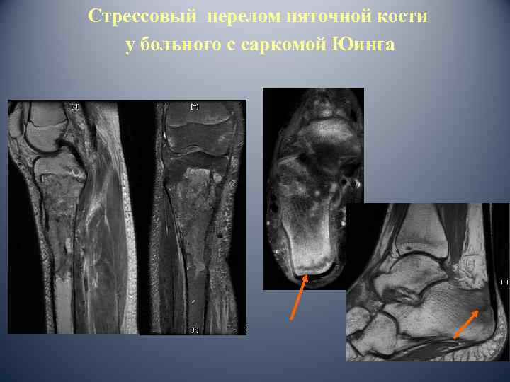 Стрессовый перелом пяточной кости у больного с саркомой Юинга 