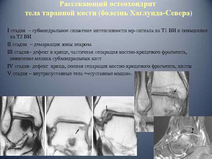 Рассекающий остеохондрит тела таранной кости (болезнь Хаглунда-Севера) I стадия – субхондральное снижение интенсивности мр-сигнала