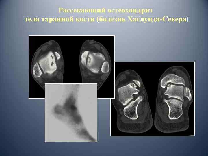 Рассекающий остеохондрит тела таранной кости (болезнь Хаглунда-Севера) 