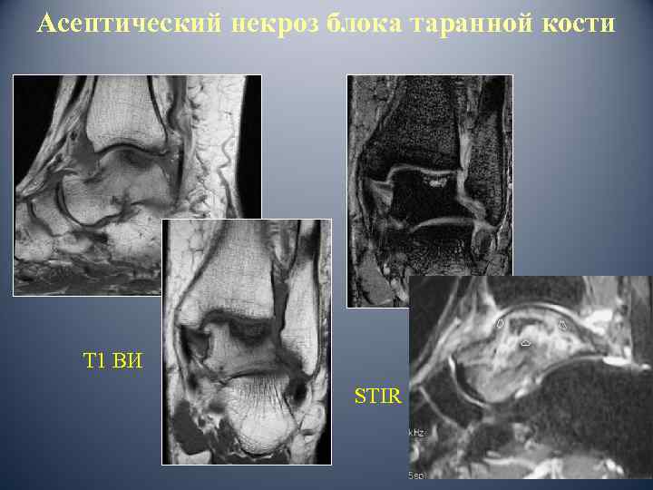 Асептический некроз блока таранной кости Т 1 ВИ STIR 